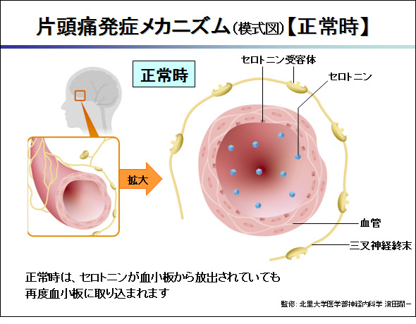 頭痛 片